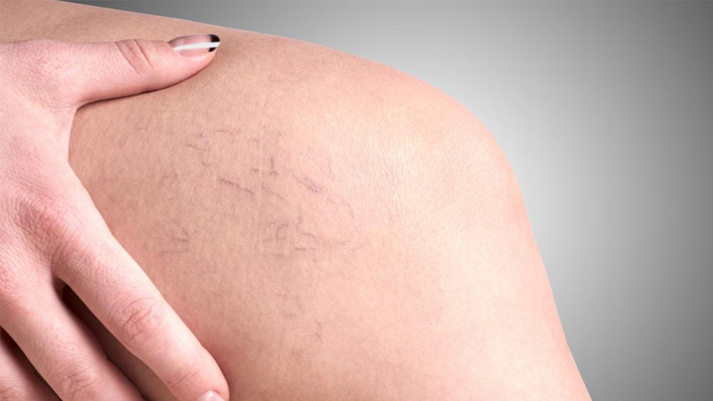 Why It's Important to Treat Spider Veins Early