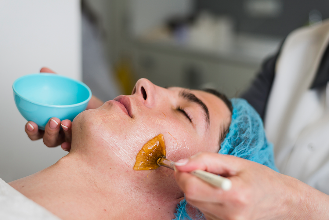 What Results Can You Expect From Chemical Peels For Acne Scars?