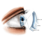 Extended depth of focus iols Specs Removal Surgery - Narayana Nethralaya