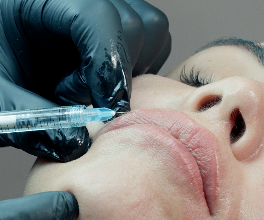 Natural Lip Enhancement with Lip Fillers Cape Town Care