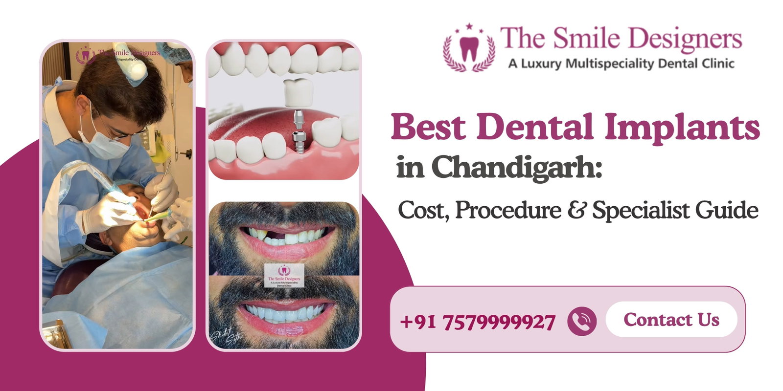 Best Dental Implants in Chandigarh - The Smile Designers