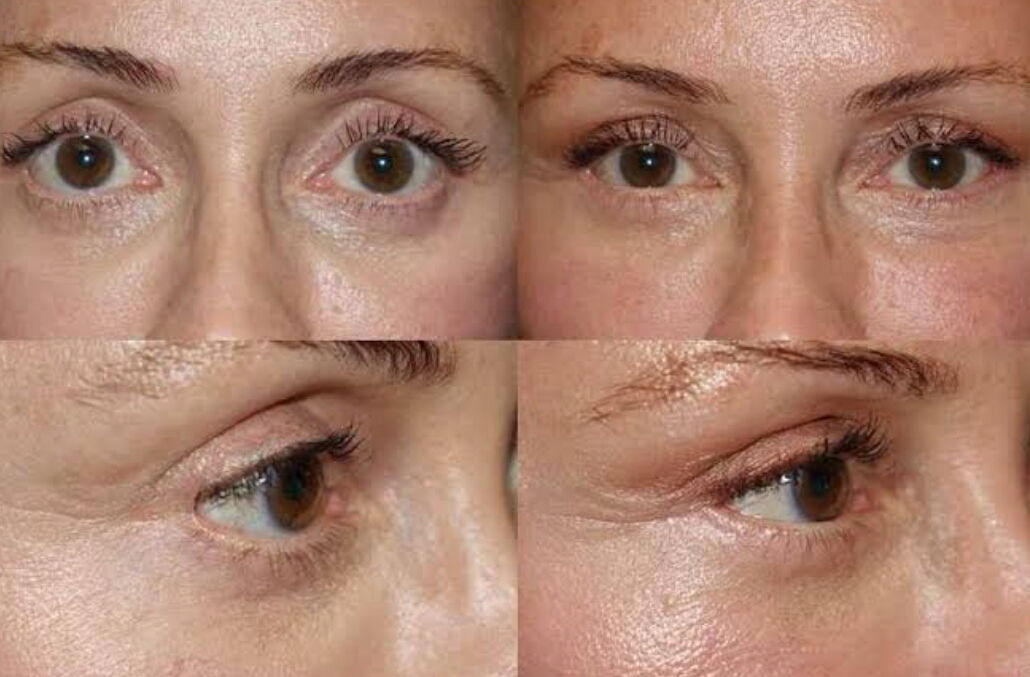 Revision - New Health For Your Eyes