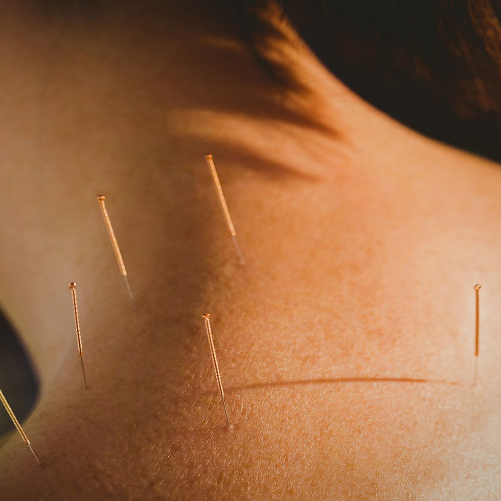 Transform Your Health with Jason Kim Acupuncture in Orange County, CA | New York City Us