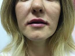 Phenol Croton Oil Peel